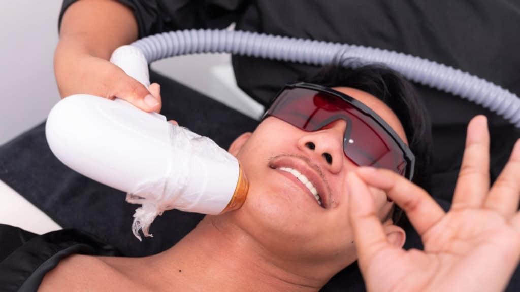 Laser Haarentfernung Männer In einer Sitzung werden einem Mann die Barthaare mit einem Laser entfernt.