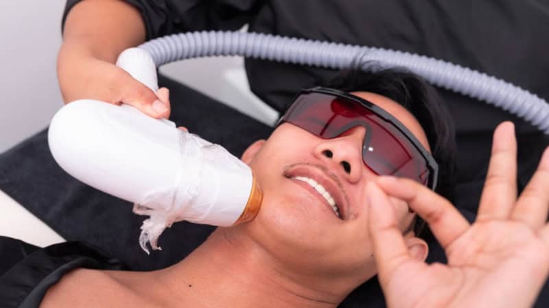 In einer Sitzung werden einem Mann die Barthaare mit einem Laser entfernt.