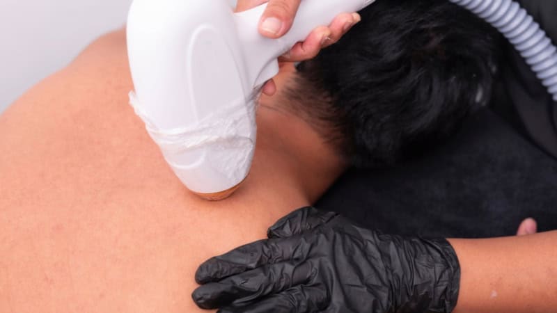 Mit einem Laser werden einem Mann Haare im Nacken entfernt.